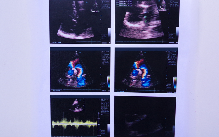 Echocardiogram | Clinton, NJ