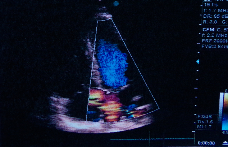 Echocardiogram | Clinton, NJ